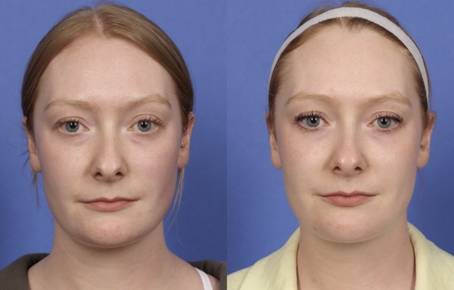 قبل و بعد از Restylane Eyelight